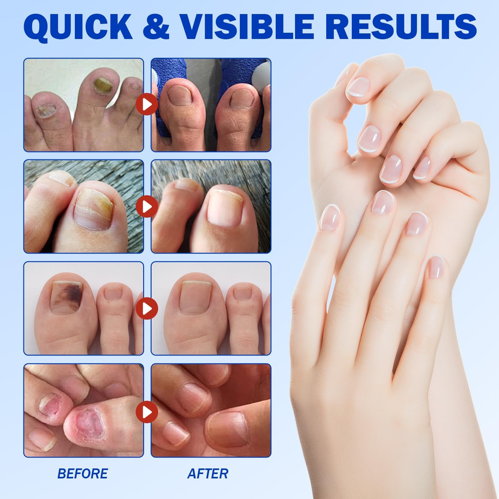 Nail Patches 42 PCS Toenail Treatment Extra Strength 8-Hour Overnight Fast Repai